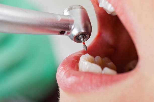 Best Emergency Dentist for Lost Fillings or Crowns in Westbury, NY